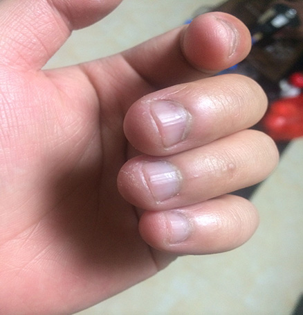 甲癣的危害不只有碍美不雅