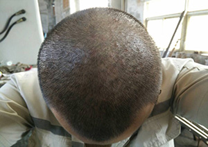 脂溢性毛囊炎怎么办
